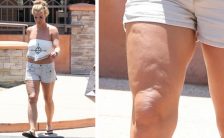 cellulite la cura alla buccia darancia