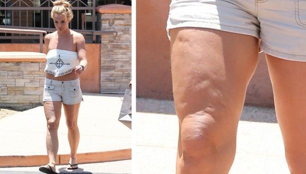 Cellulite, la cura alla buccia d’arancia