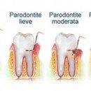 Parodontite