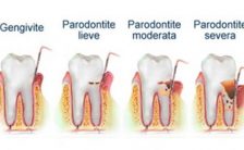 parodontite come si manifesta e come curarla