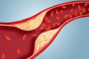 Colesterolo alto, arriva il farmaco miracoloso