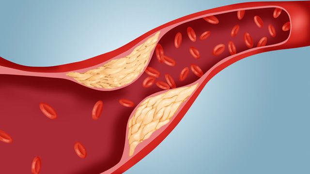 Colesterolo alto, arriva il farmaco miracoloso