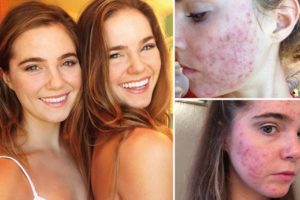 Acne cistica, due sorelle la combattono con la dieta