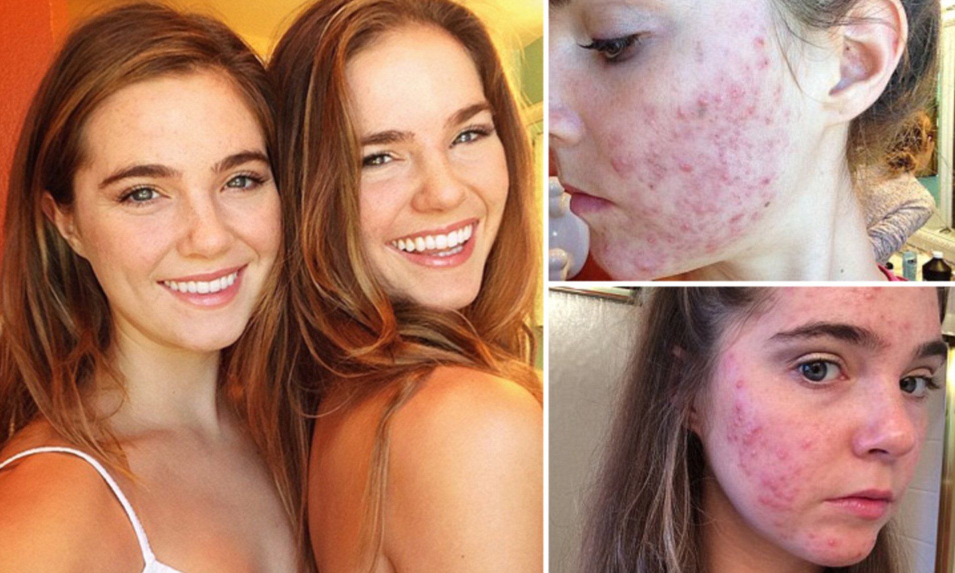 Acne cistica, due sorelle la combattono con la dieta