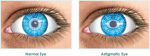 Laser miopia e astigmatismo: sta diventando una mania