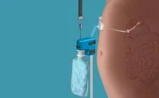 il nuovo prodotto per dimagrire risucchia via il cibo