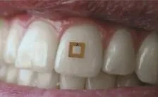 il conta calorie che si attacca ai denti letteralmente